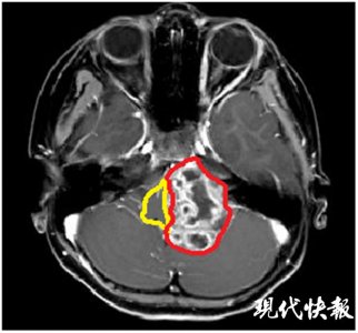 ​6岁宝宝患脑肿瘤 偏偏还是熊猫血